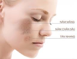 Kem trị nám 14 ngày với peptide làm trắng thế hệ mới, kích hoạt bốn cơ chế trị nám da