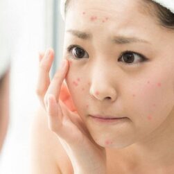 Có gì mới về mụn trứng cá?